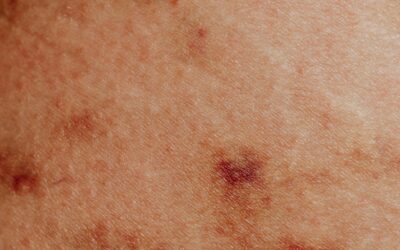 WHO declares Mpox a public health emergency of international concern